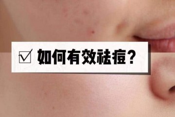 史上最全祛痘大法知道痘痘都是哪来的才干完全处理问题哦