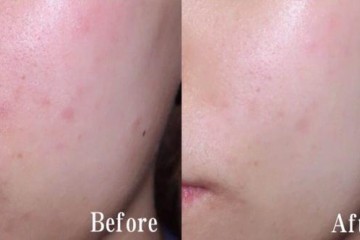 油痘肌该怎么样选爽肤水清新和舒缓排首位你选对了吗